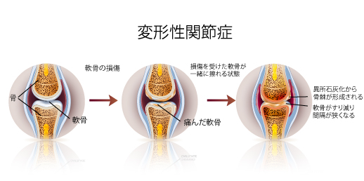 膝の関節痛 予防と改善